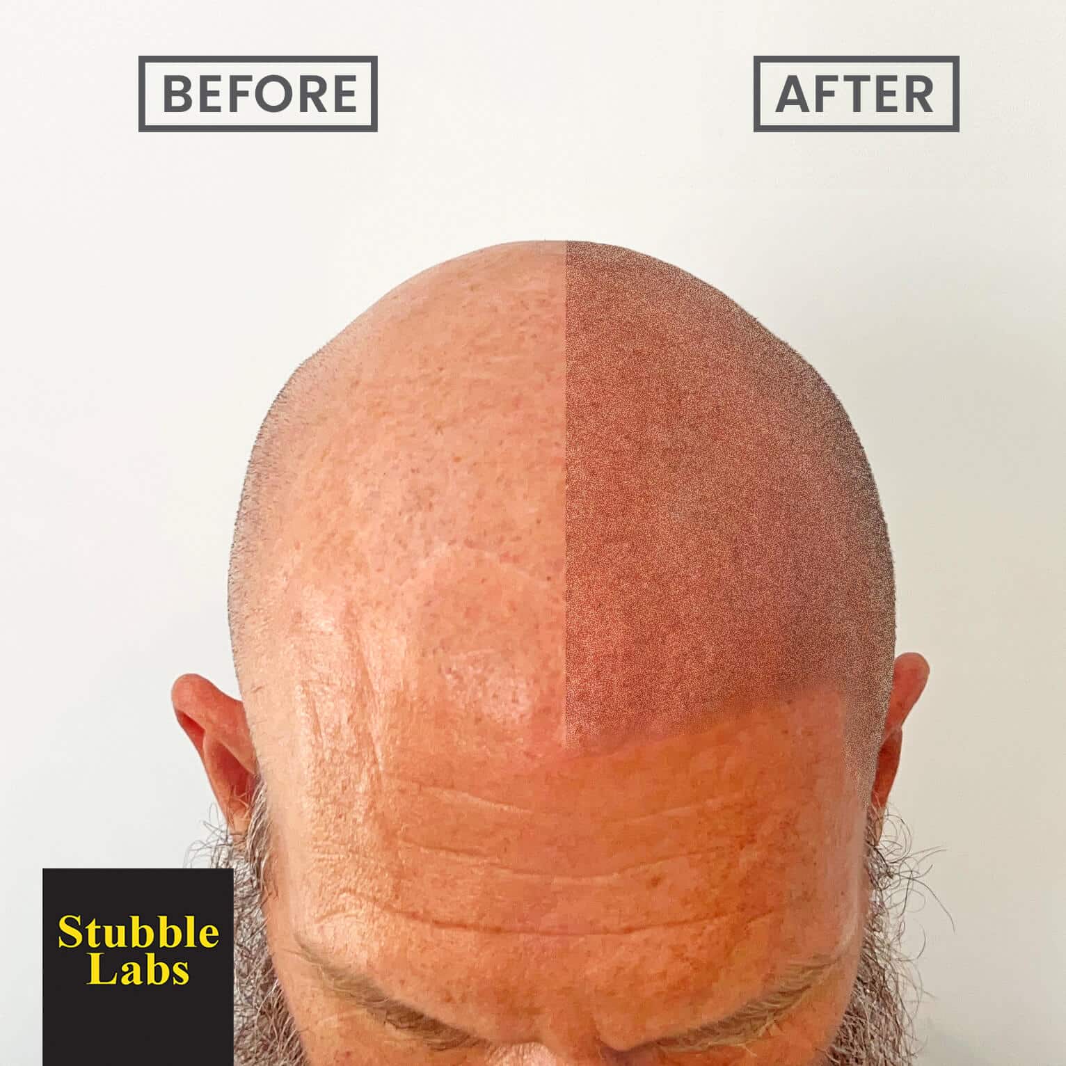 Now you can fix baldness instantly