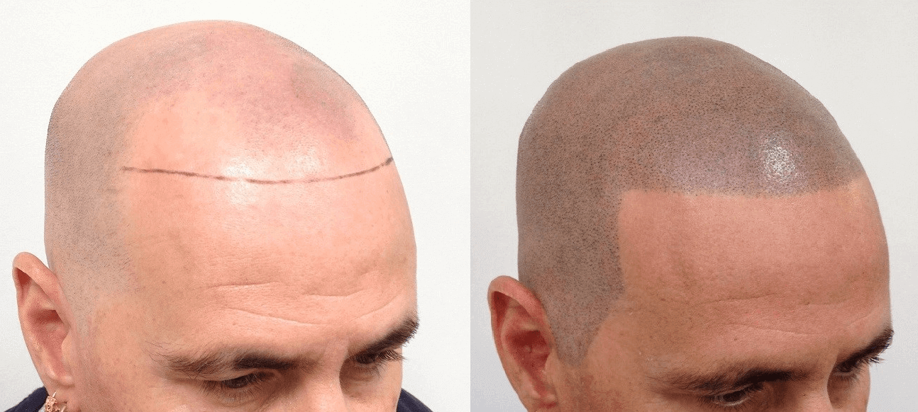 pros and cons of scalp tattoos