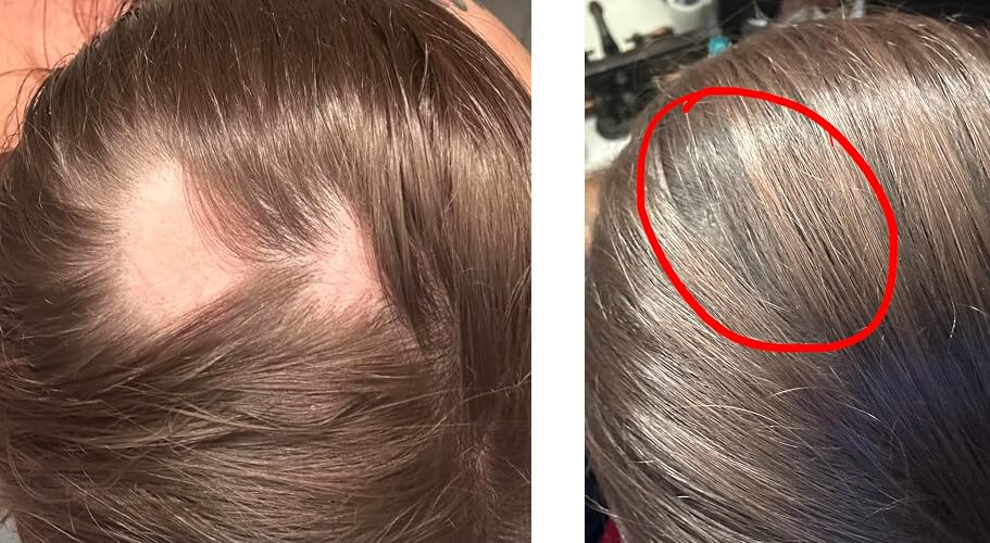solution for alopecia